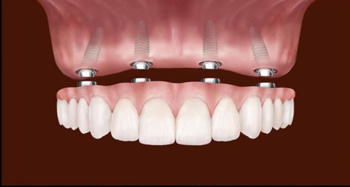 Ilustração de prótese sobre implantes dentários